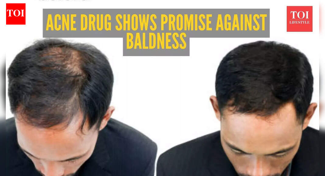 Breakthrough in finding cure for baldness: Common acne drug shows remarkable results in treating Male Pattern Baldness
