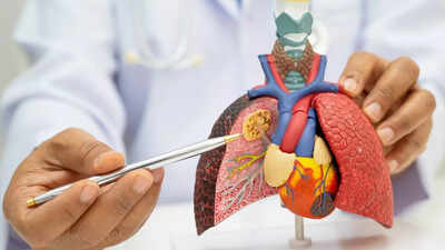 Pneumonia vs. Lung Cancer: How to spot the key differences, key symptoms, causes and key prevention tips