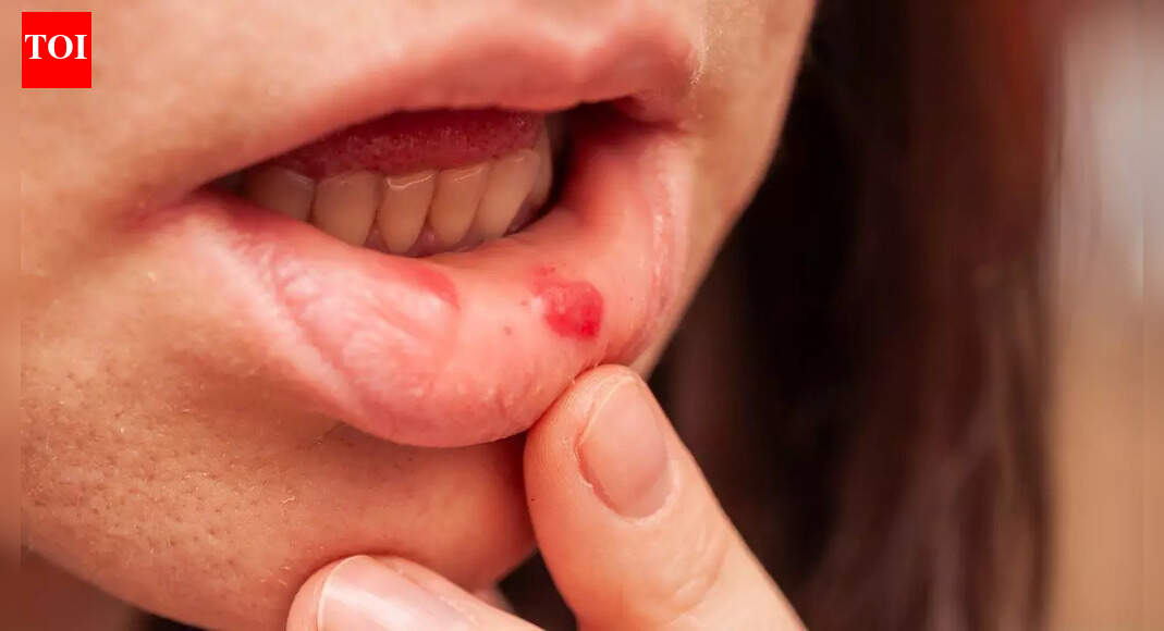 Mouth ulcers may signal hidden diseases: Health conditions they are linked to, who is at risk, and prevention tips