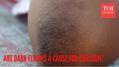 Are darkened elbows a cause for concern? Here's what it means