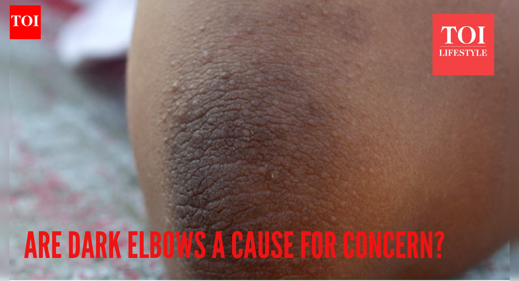 Are darkened elbows a cause for concern? Here's what it means