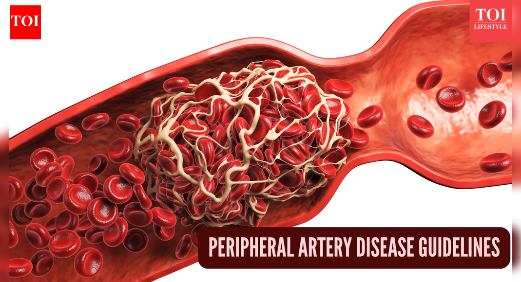 Cleveland Clinic helps shape new guidelines for peripheral artery disease care