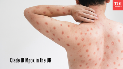 Clade IB Mpox in the UK: Symptoms, risks, and public health response