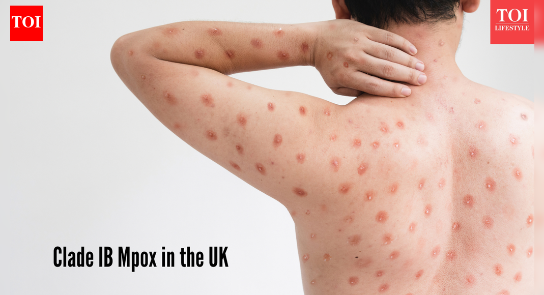 Clade IB Mpox in the UK: Symptoms, risks, and public health response