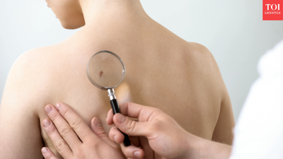 Judge Frank Caprio's son David Caprio warns about skin cancer after an alarming dermatologist visit