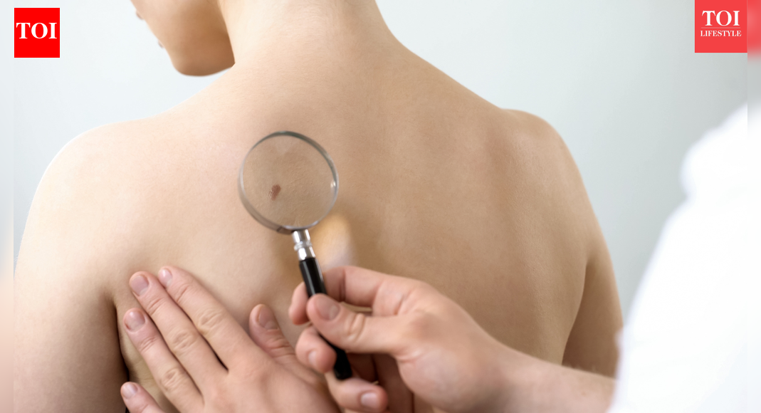 Judge Frank Caprio's son David Caprio warns about skin cancer after an alarming dermatologist visit