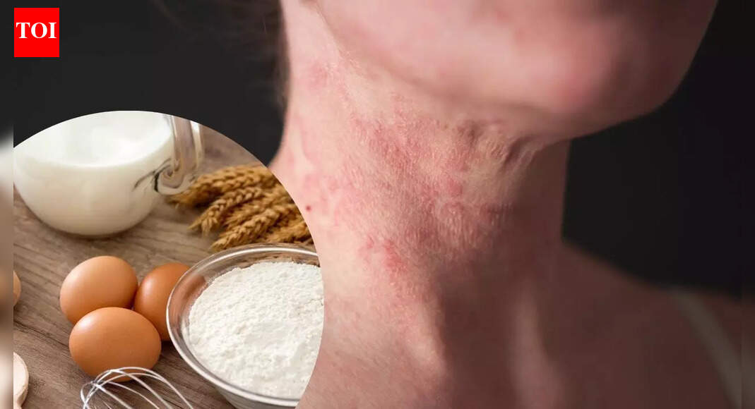 Eczema food guide: What triggers symptoms and what helps