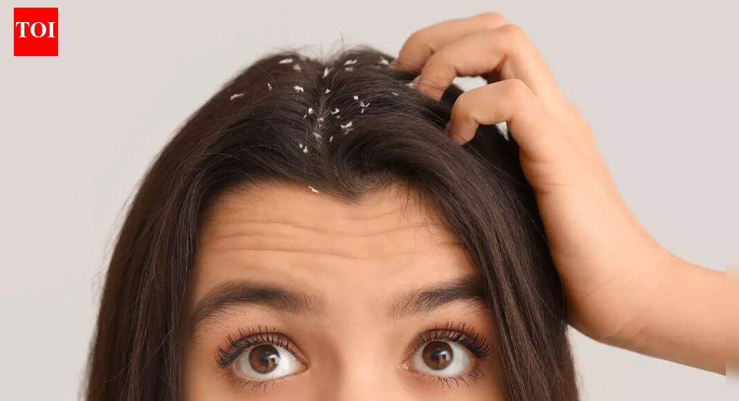 Dandruff is more than just poor hygiene; know what your scalp is telling you