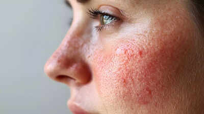 13 things that secretly trigger acne at home and cause breakouts (number 3 is shocking)