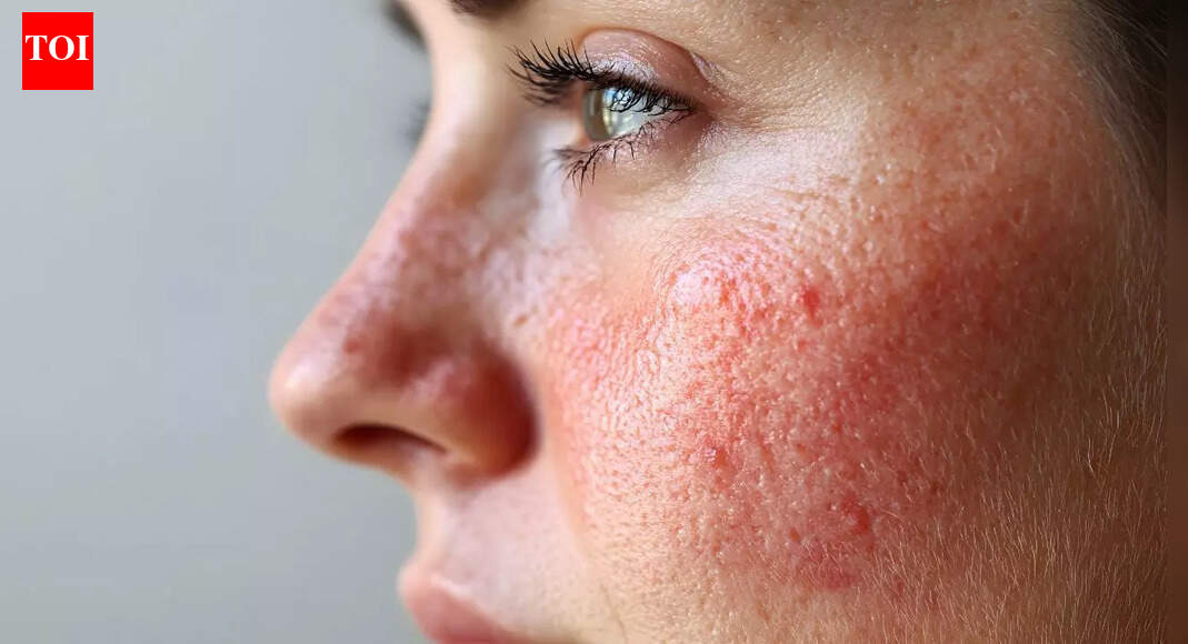 13 things that secretly trigger acne at home and cause breakouts (number 3 is shocking)