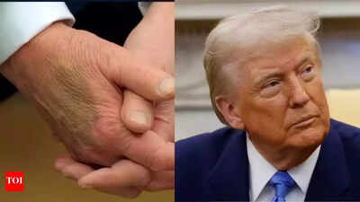 Compression socks, aspirin and makeup: Trump admits concealing visible signs of health problems