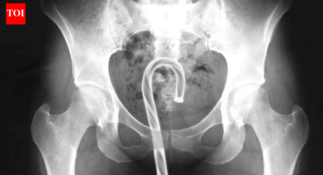 US government releases list of unusual objects surgically removed from people's rectums in 2025