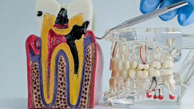 When a routine tooth extraction triggers a sight-threatening eye emergency days later