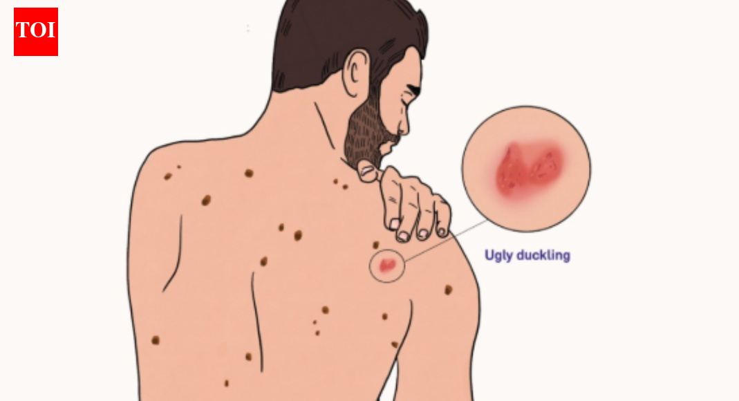 Ugly duckling sign for melanoma: Symptoms, studies, and self-check tips