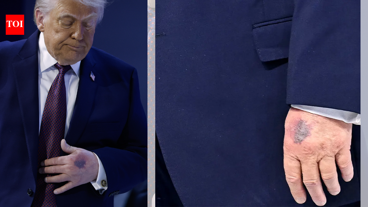 Row over Trump’s hand bruise in Davos and ‘missing medical records’: ‘Two years of Biden’s health…’