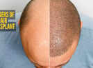 5 possible side effects of a hair transplant you should know about before booking one
