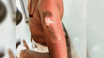 'Not waking up on time for school': Tamil Nadu man brands his 10 year-old son with hot knife in Vellore; arrested