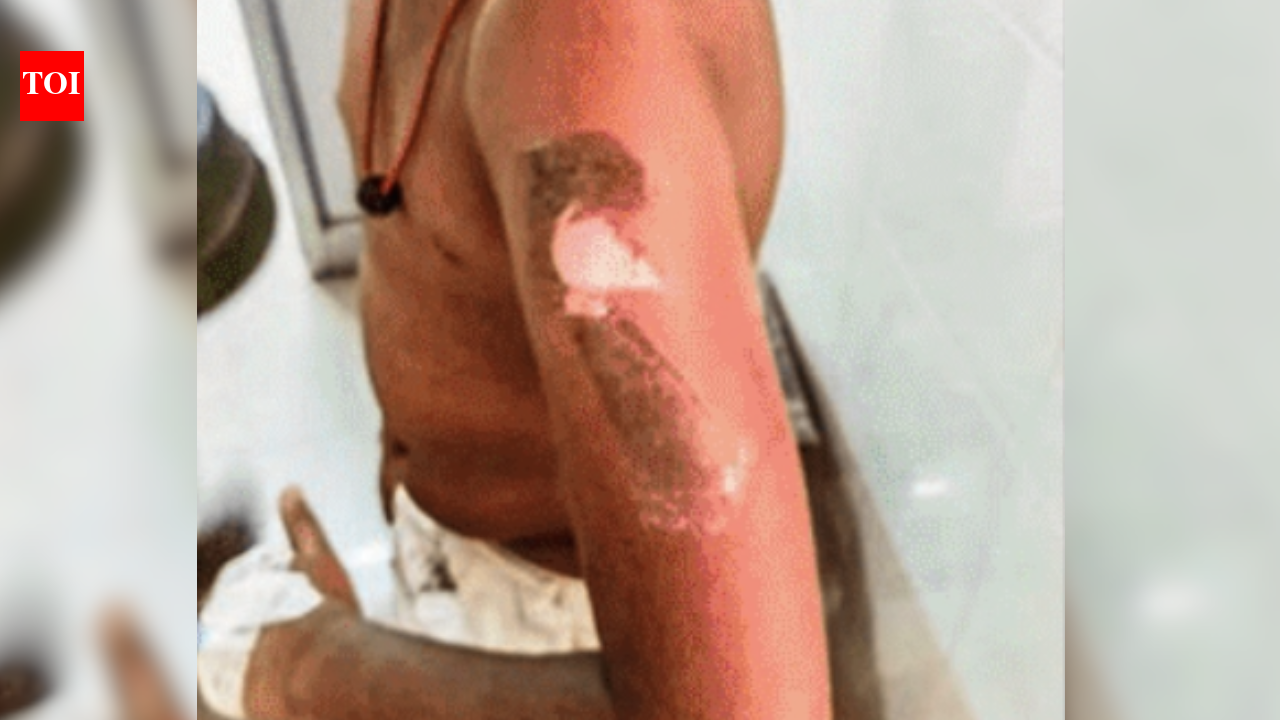 'Not waking up on time for school': Tamil Nadu man brands his 10 year-old son with hot knife in Vellore; arrested