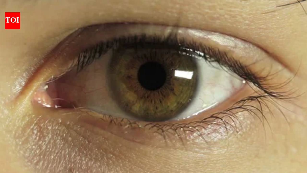 Teen worker injures eye in Pune, doctors help him regain partial vision