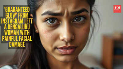 Bengaluru woman says Instagram beauty treatment left her face burned and swollen