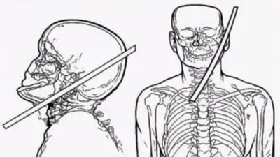 Man lives after rod pierces neck, narrowly misses brain and spine in Gurgaon; no neurological deficits