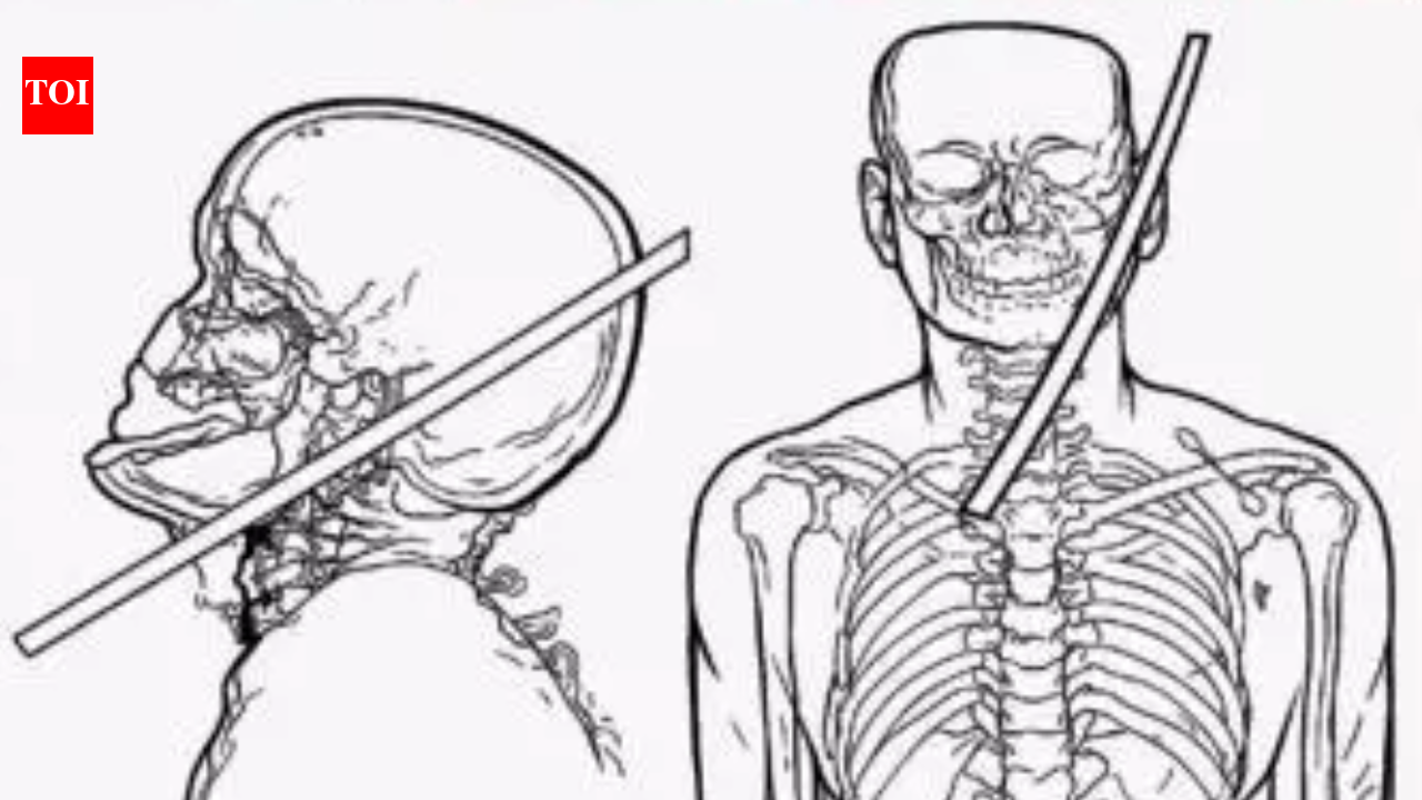 Man lives after rod pierces neck, narrowly misses brain and spine in Gurgaon; no neurological deficits