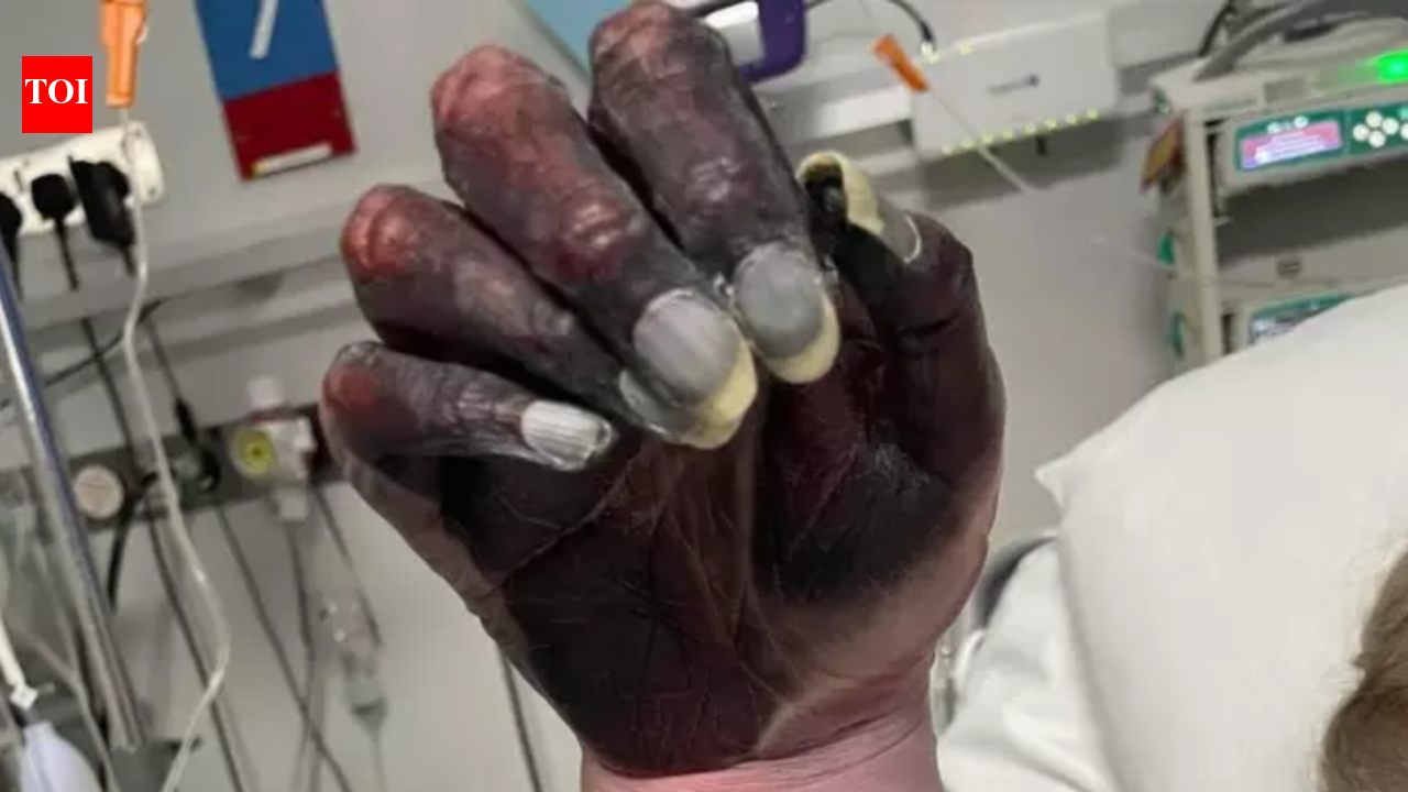 Mother dies after arm amputation as doctors dismiss blackened hand as ‘newspaper ink’