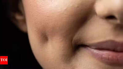 Dimple isn’t simple! Bengalureans shelling out up to Rs 60,000 to carve that perfect smile