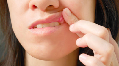 Cancer can start as simple mouth sores or white patches: Don’t ignore minor changes in the mouth, urges doctor