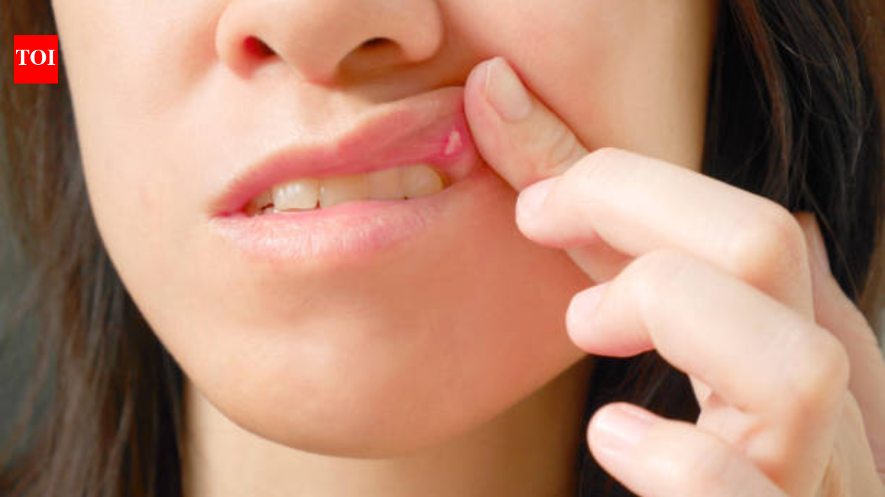 Early Signs Of Oral Cancer: Oncologist urges attention to persistent mouth sores