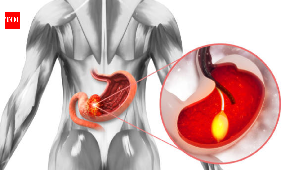 Delhi man with advanced pancreatic cancer undergoes complex surgery involving “replumbing” of the digestive system