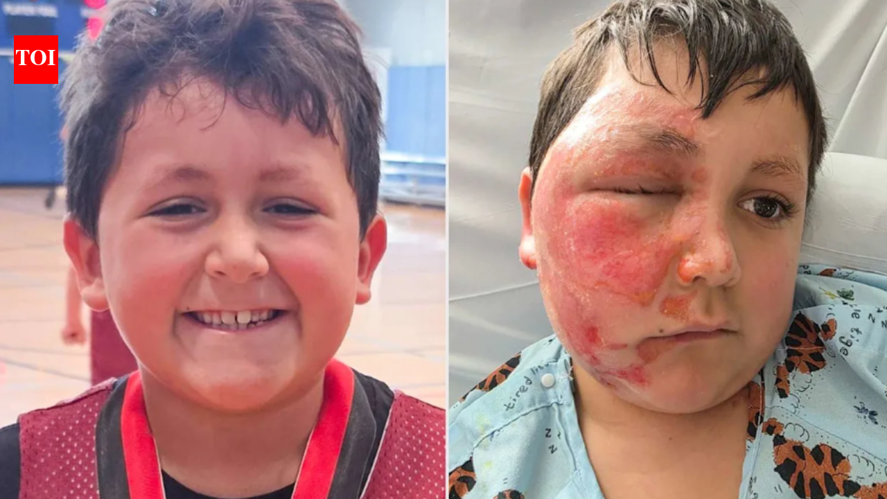 9-year-old suffers severe burns after copying viral TikTok trend; authorities report multiple victims