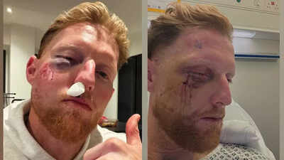 Ben Stokes undergoes facial surgery after freak nets blow, England captain shares pic