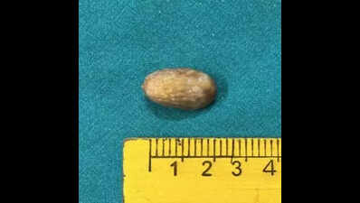 NRS docs remove 2-cm seed lodged in 13-year-old’s airway