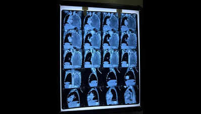 3-year-old on road to recovery after rare lung tumour surgery