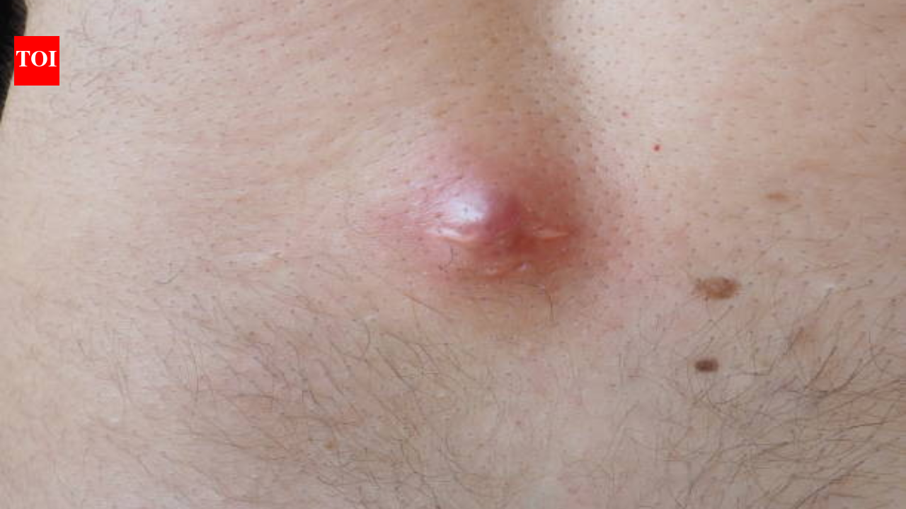 Rare chest cyst in 43-year-old man treated using robotic surgery