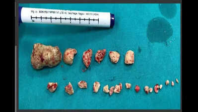 Thought of food hurts? City hospital leads in rare procedure