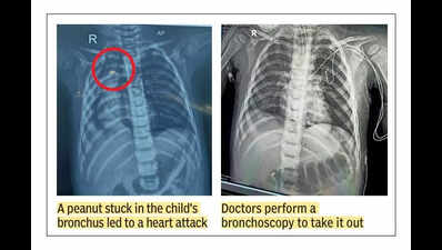 Peanut stuck in airway for 2 days, toddler suffers cardiac arrest; saved after 6-hr operation at Noida hospital