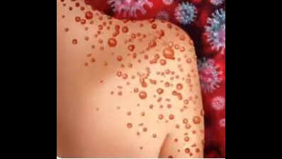 TN ups surveillance as chickenpox cases rise among children