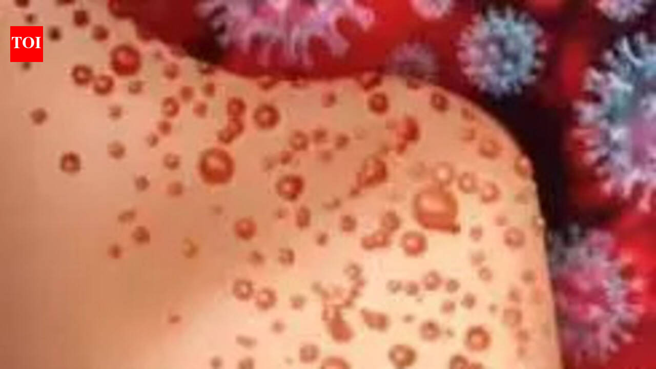 TN ups surveillance as chickenpox cases rise among children