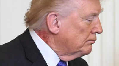 Donald Trump appears with red rash on neck - his doctor explains what happened