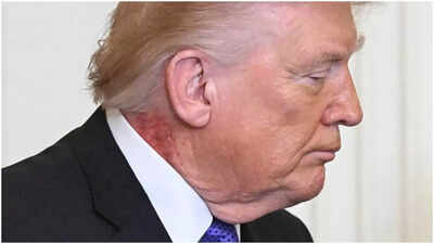  Trump health chatter erupts after red rash spotted on neck, MAGA rushes to defend president