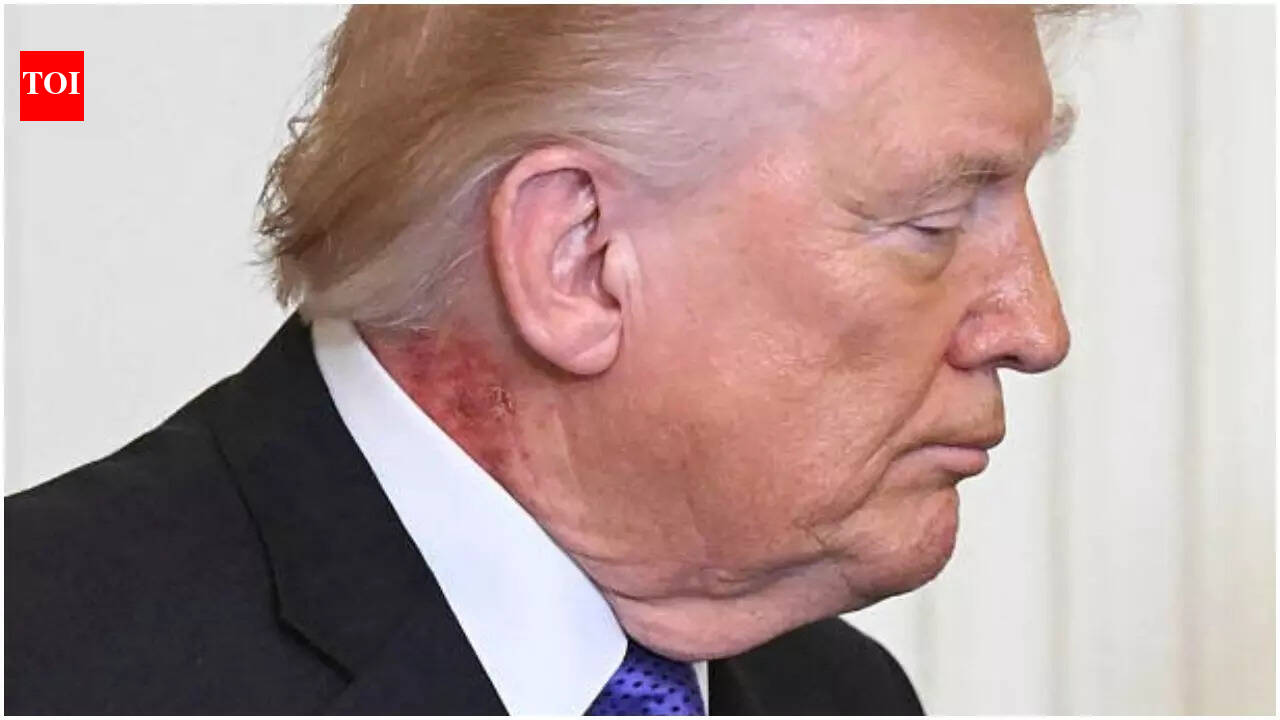 'It was very common cream': Trump health chatter erupts after red rash spotted on neck, MAGA rushes to defend president