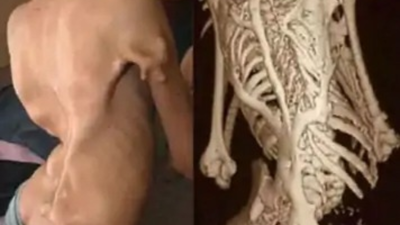 Extremely rare FOP disease detected in Jaisalmer, Rajasthan for 1st time; muscles gradually turn into bone