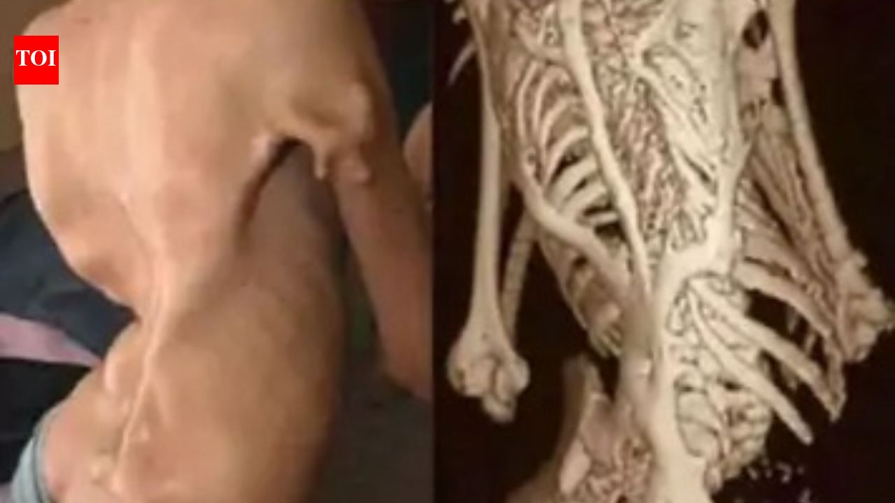 Extremely rare FOP disease detected in Jaisalmer, Rajasthan for 1st time; muscles gradually turn into bone