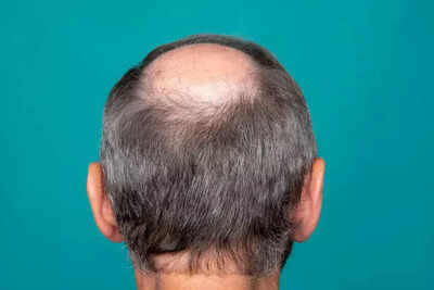 Men across India are going bald - but researchers say the real reason may shock you