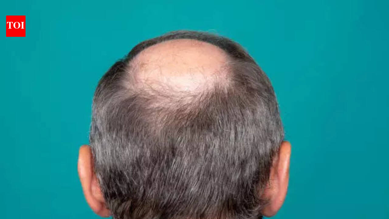 Men across India are going bald - but researchers say the real reason may shock you