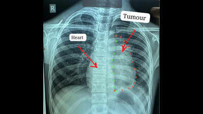 11-year-old’s rare cancer removed from heart in Raipur, Chhattisgarh's biggest hosp claims world first
