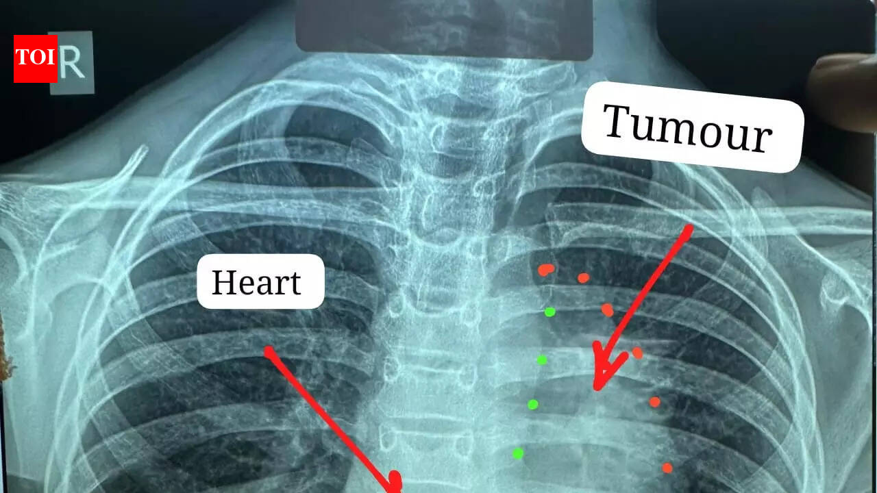 11-year-old’s rare cancer removed from heart in Raipur, Chhattisgarh's biggest hosp claims world first