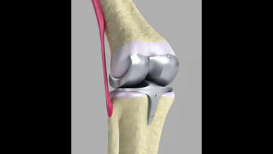 Titanium orthopaedic supply could become a casualty of Gulf crisis